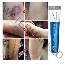 [당일출고] 흉터제거 크림 여드름 상처 제거 연고 얼굴 바디 외상 연고, 1개, 1개